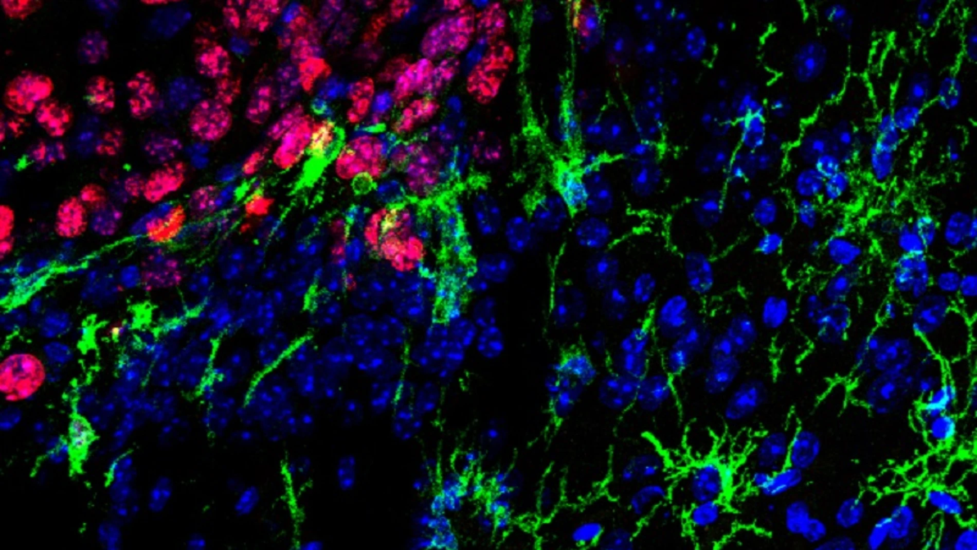 Células de la microglía (en verde) infiltrándose entre las células tumorales de una metástasis de melanoma (en rojo)
