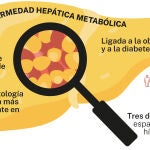 Hígado graso