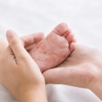 Niño con sarampión