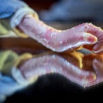 Campaña, titulada ‘Cicatrices’: una iniciativa para concienciar sobre el impacto psicológico de la enfermedad Piel de Mariposa