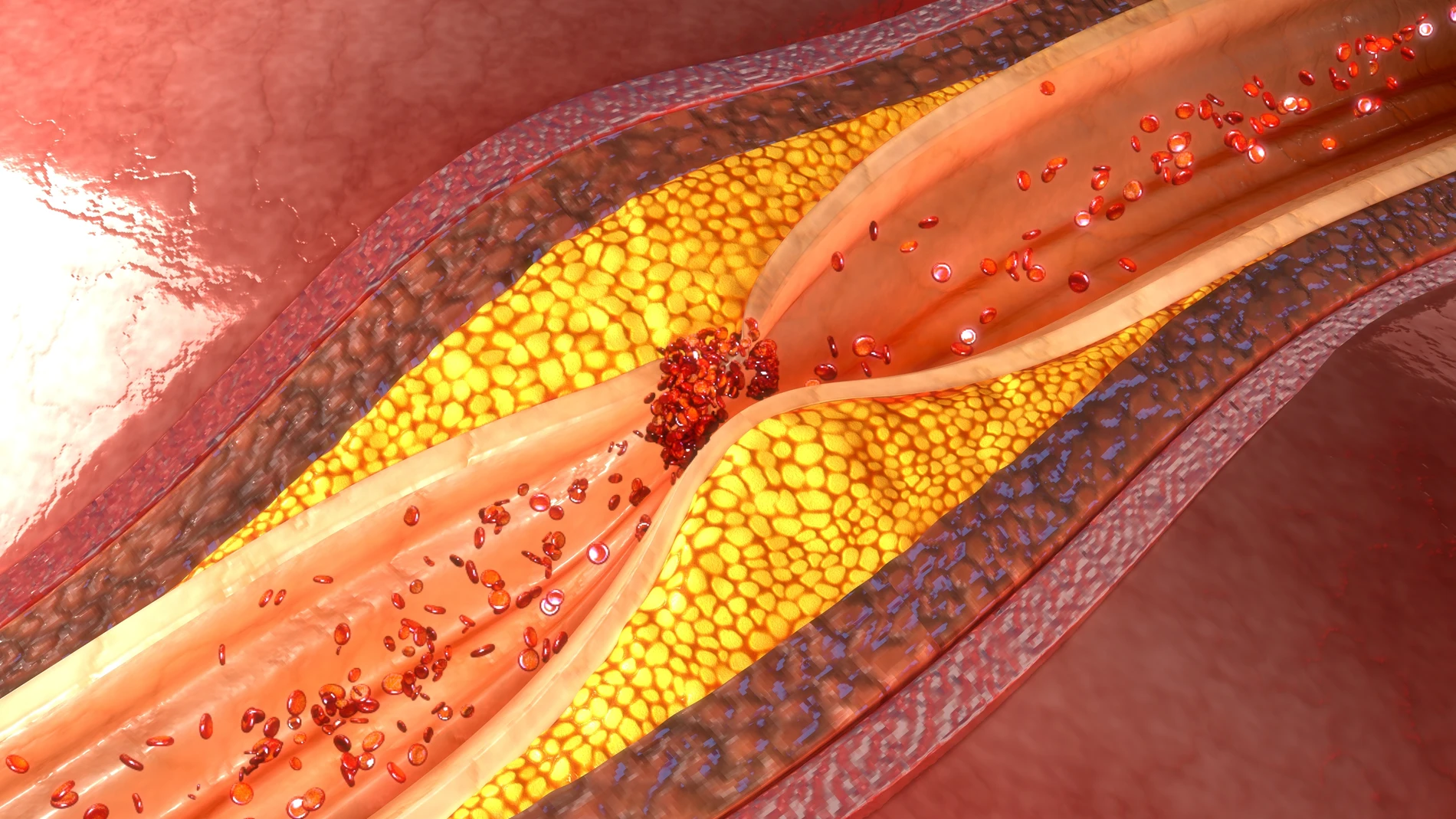 La ateroesclerosis es una enfermedad inflamatoria crónica que se caracteriza por la acumulación de lípidos y leucocitos en la pared arterial