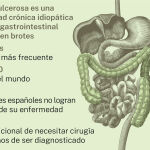 Colitis ulcerosa
