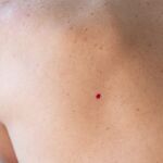 Lunares rojos en la piel: qué son y qué dicen sobre tu salud