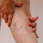 Varices 