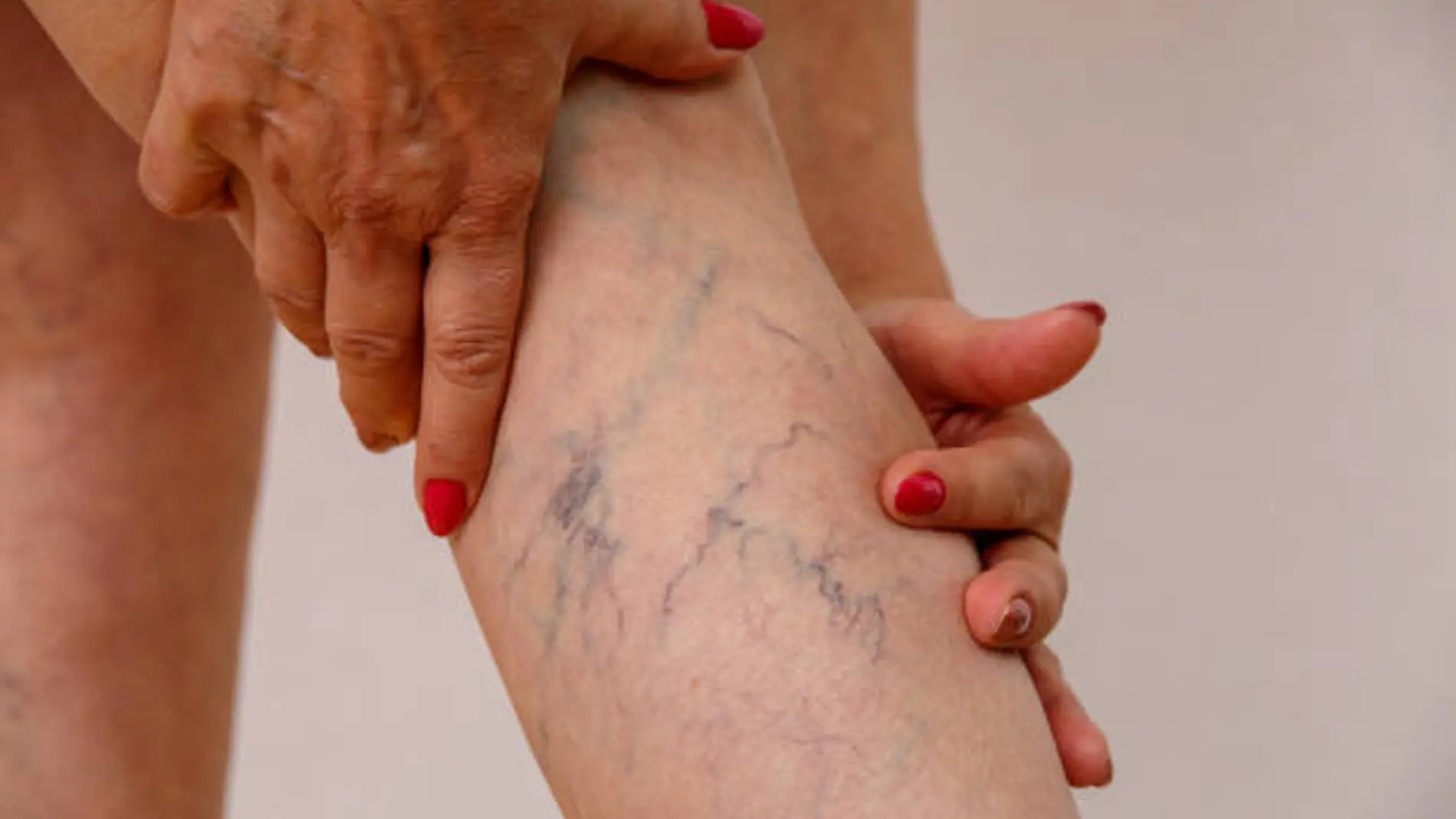 Varices