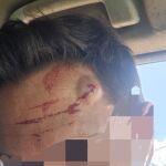 Las heridas de un guardia civil al tratar de impedir un salto en la valla de Ceuta
