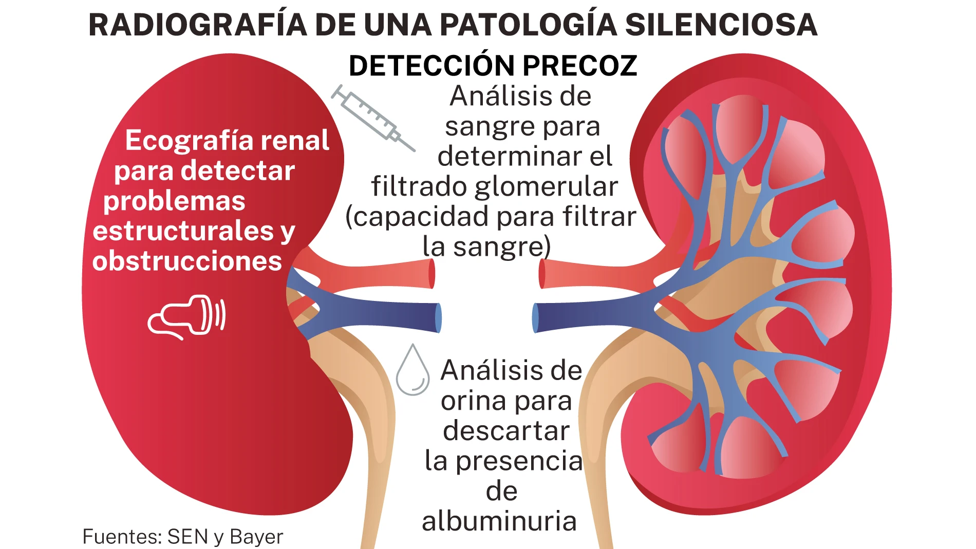 Enfermedad renal crónica
