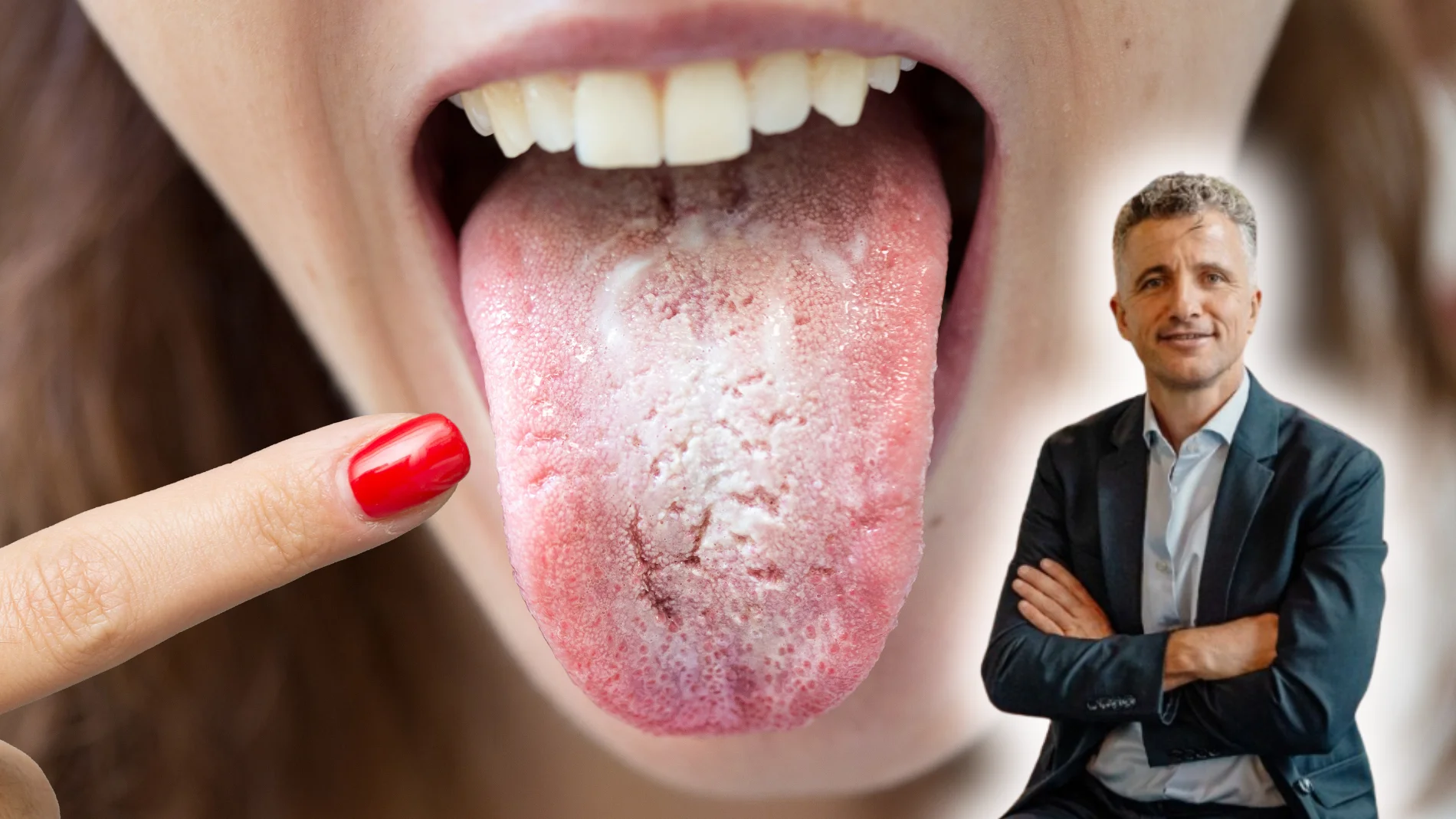 ¿Tienes marcas blancas en la lengua? Esto es lo que pueden estar indicándote según un experto