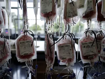 Esta patología implica exceso de hierro en la sangre Esta patología implica exceso de hierro en la sangre