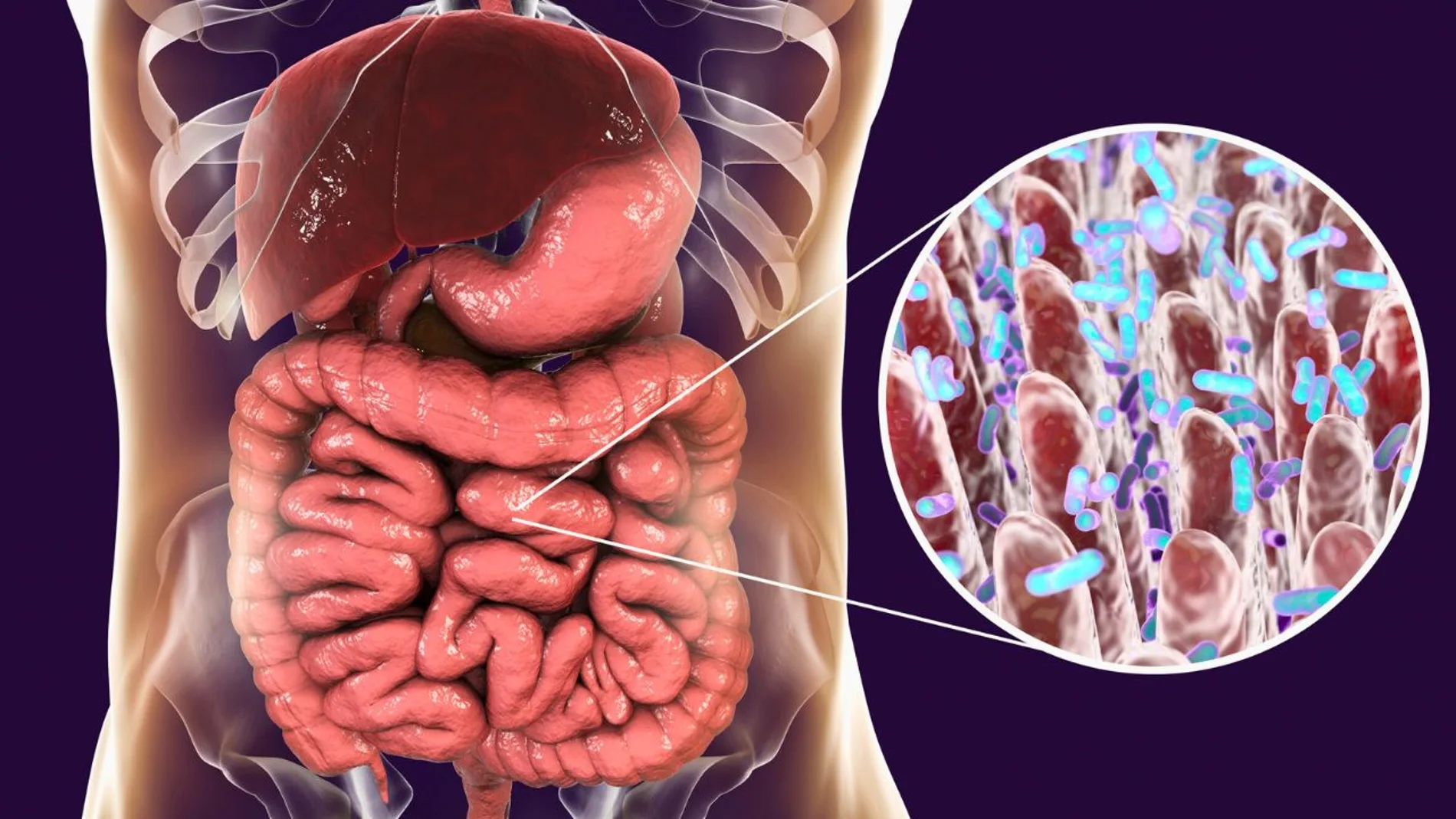 La bacteria Helicobacter tiene relación con el cáncer gástrico