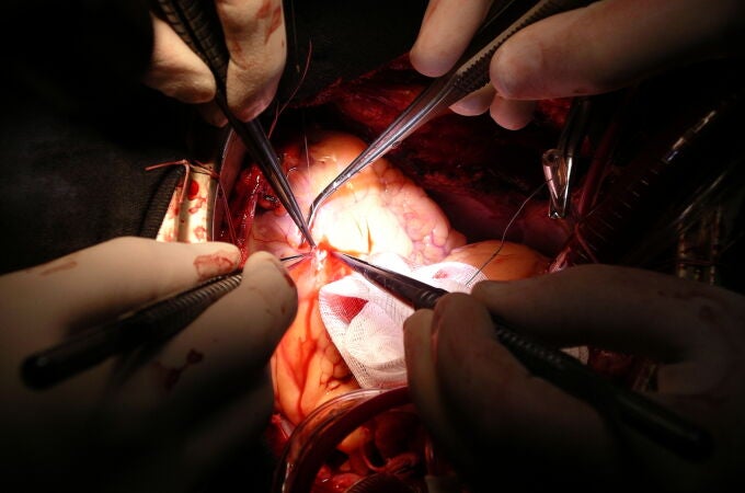 El 50% de los trasplantes cardiacos que se realizan en España son de carácter urgente