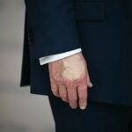 Especulación sobre la mano derecha de Donal Trump, cubierta con maquillaje