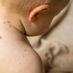 Esta es la enfermedad "extremadamente infecciosa" que ha puesto en jaque a un importante aeropuerto en Estados Unidos