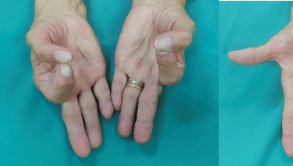 Rizoartrosis en ambas manos tras una artroplastia, sin apenas complicaciones 25 años después