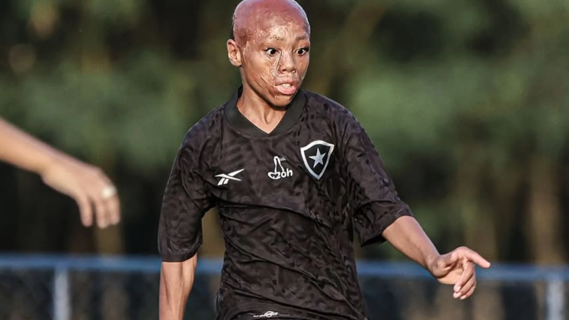 Bernardo Lopes, de sobrevivir a quemaduras a ser el nuevo fichaje de Botafogo