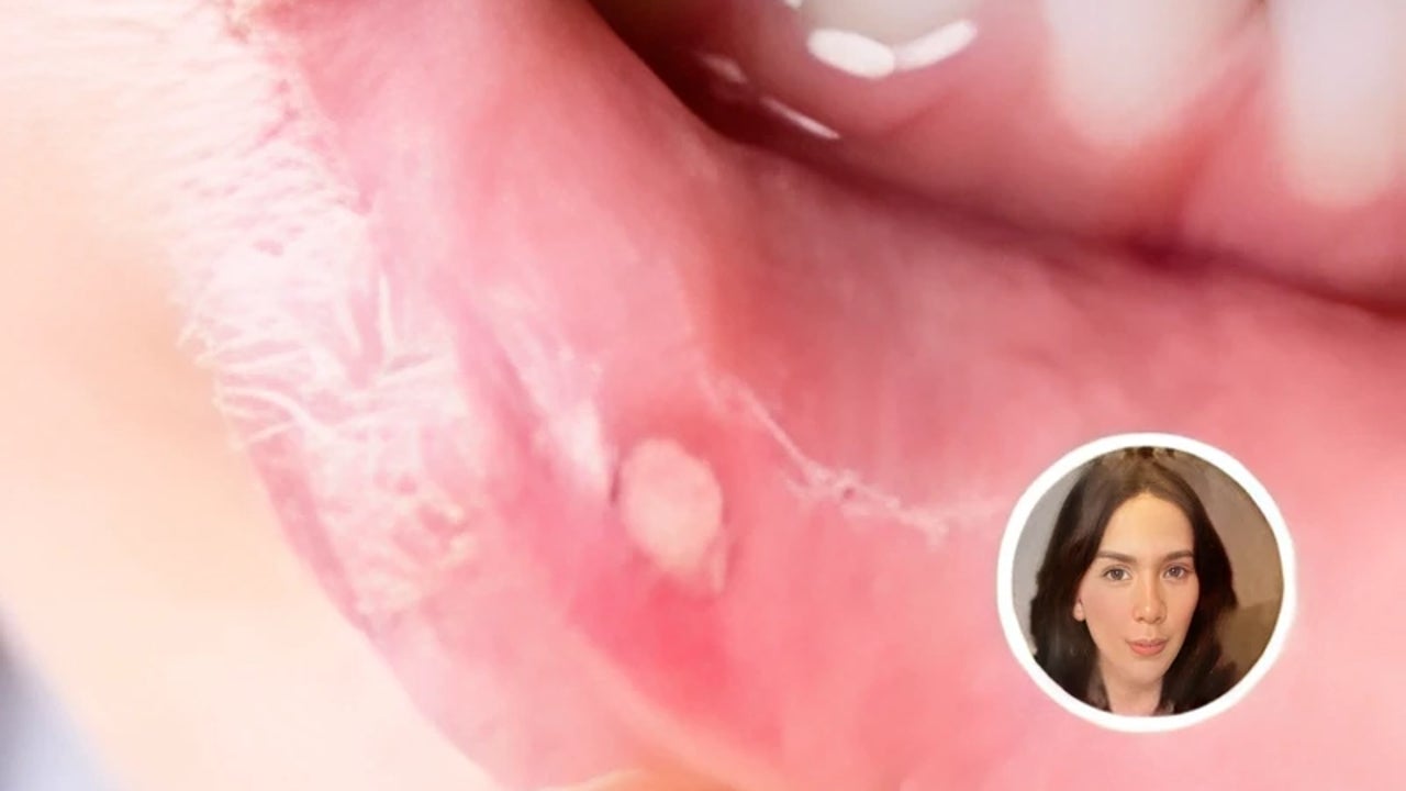 ¿Por qué salen llagas en la boca? Esta médica especialista en endocrinología lo explica