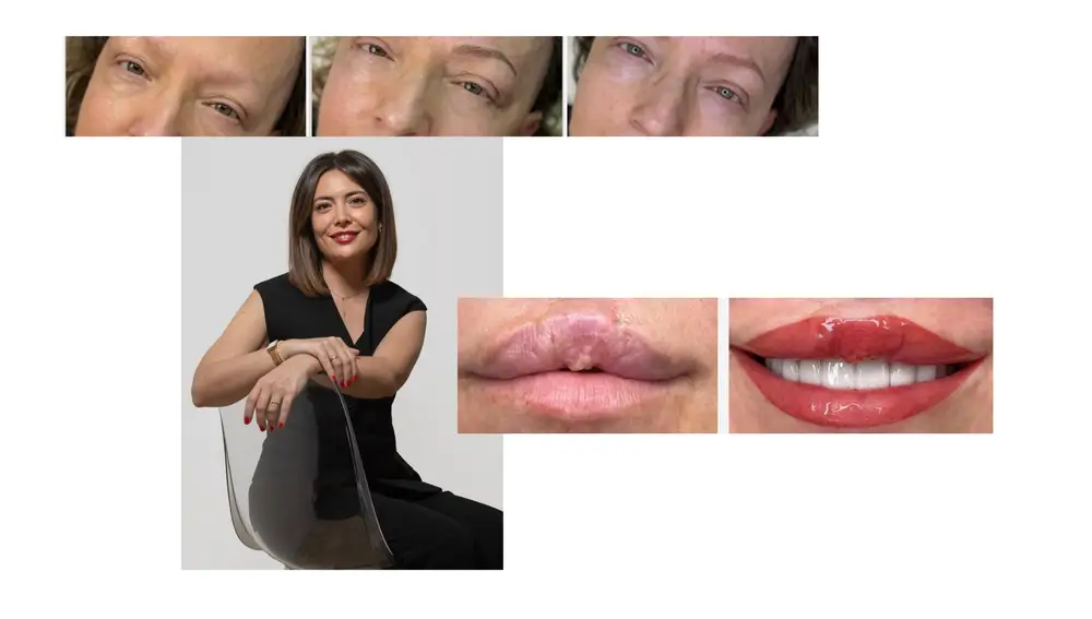 Resultados de la micropigmentación.