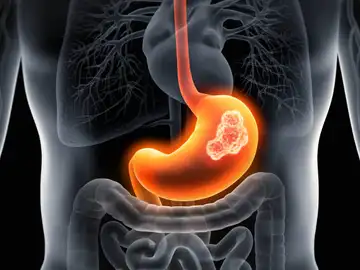 Cáncer de estómago: estos son los síntomas y la alimentación que puede ayudar a prevenirlo Cáncer de estómago: estos son los síntomas y la alimentación que puede ayudar a prevenirlo
