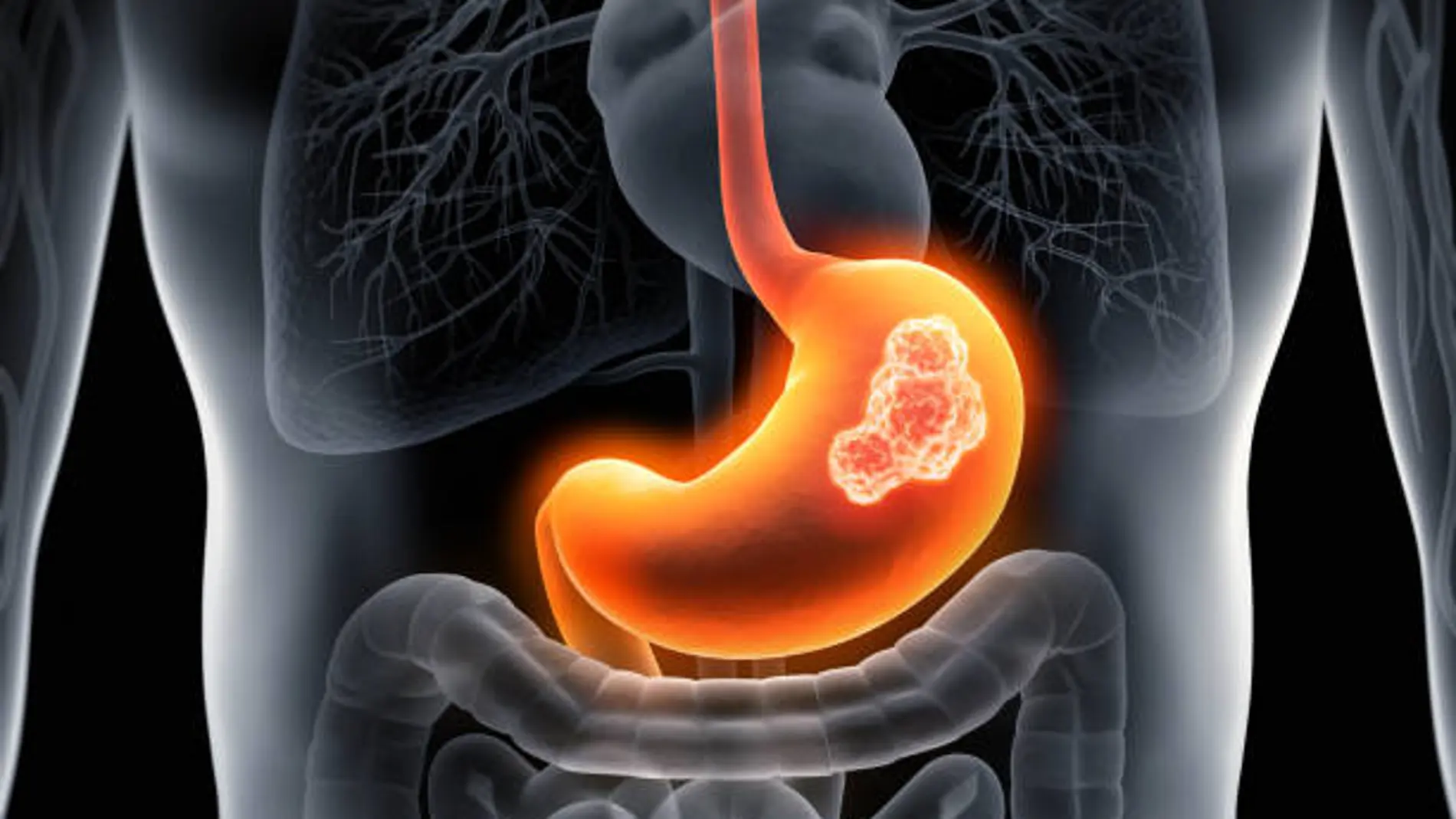 Cáncer de estómago: estos son los síntomas y la alimentación que puede ayudar a prevenirlo