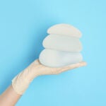 Las mujeres que se están retirando los implantes son las que se los pusieron en el "boom"