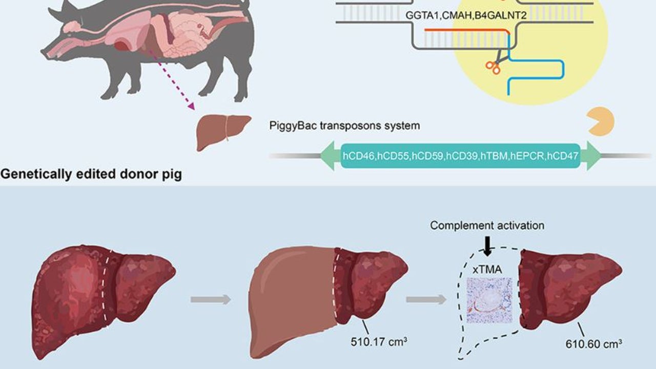 Realizan el primer trasplante de un hígado de cerdo genéticamente modificado a un paciente vivo