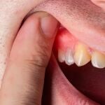 La enfermedad de las encías que podría aumentar el riesgo de cáncer de próstata, según un estudio La enfermedad de las encías que podría aumentar el riesgo de cáncer de próstata, según un estudio