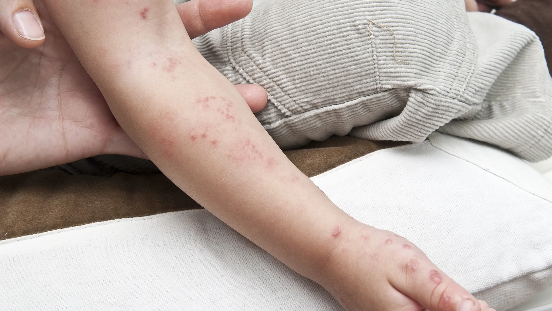 Ampollas causadas por herpes zóster en la mano y el brazo de un niño.