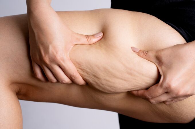 Lipedema