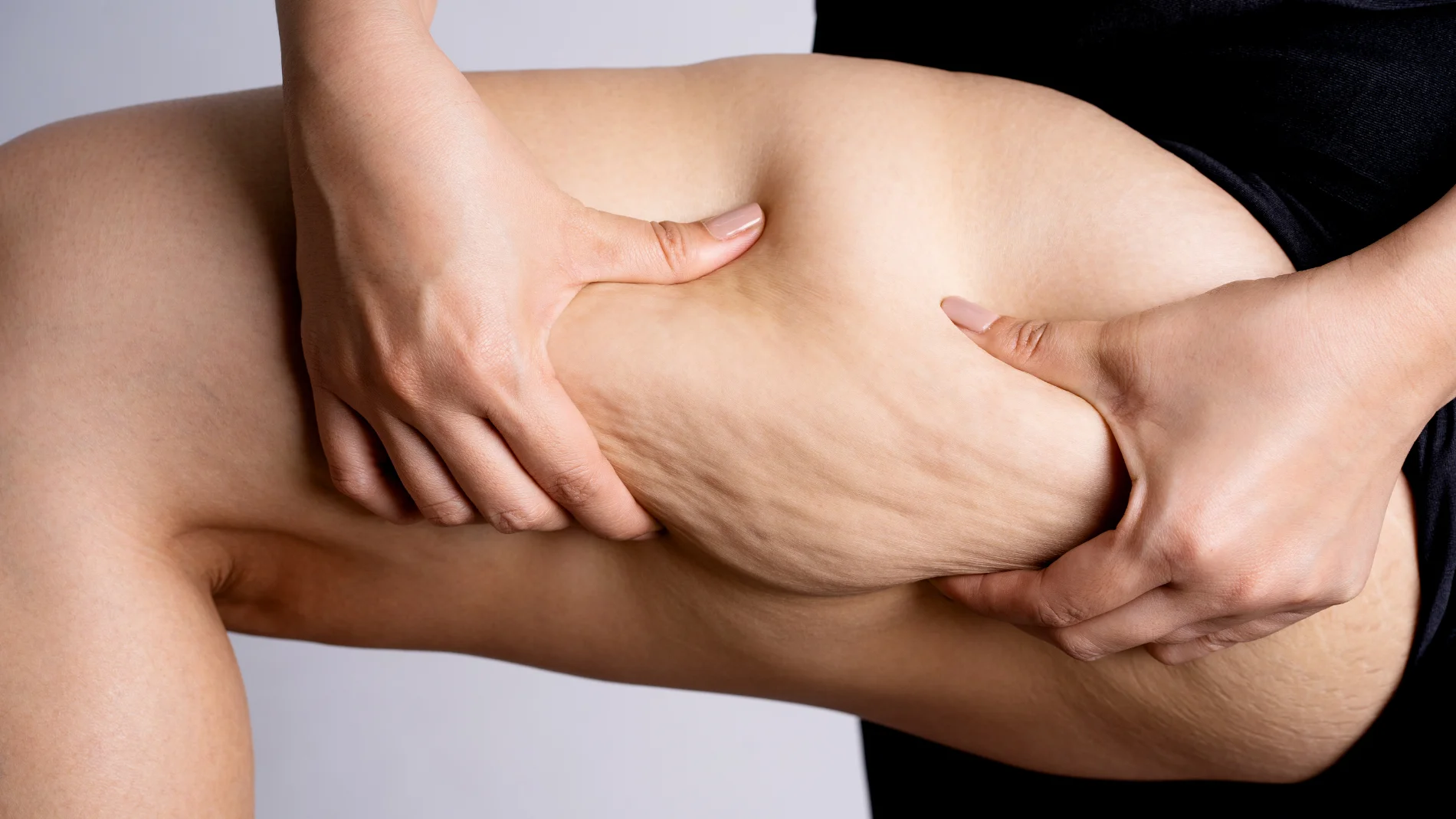 Lipedema