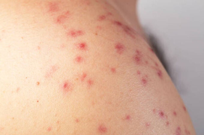 Manchas rojas en la piel: cuándo preocuparse y cuándo son inofensivas Manchas rojas en la piel: cuándo preocuparse y cuándo son inofensivas