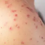 Manchas rojas en la piel: cuándo preocuparse y cuándo son inofensivas