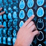 Aumentan los casos de encefalitis autoinmune