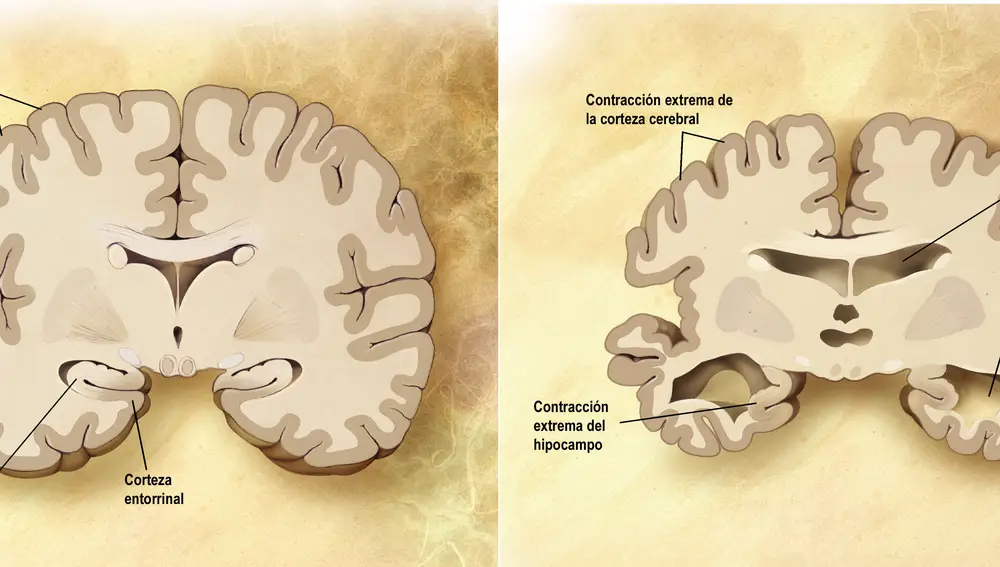 Comparación entre un cerebro normal (izquierda) y un cerebro afectado de alzhéimer (derecha).