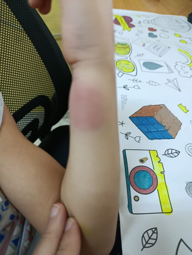 Picaduras de los insectos a los niños