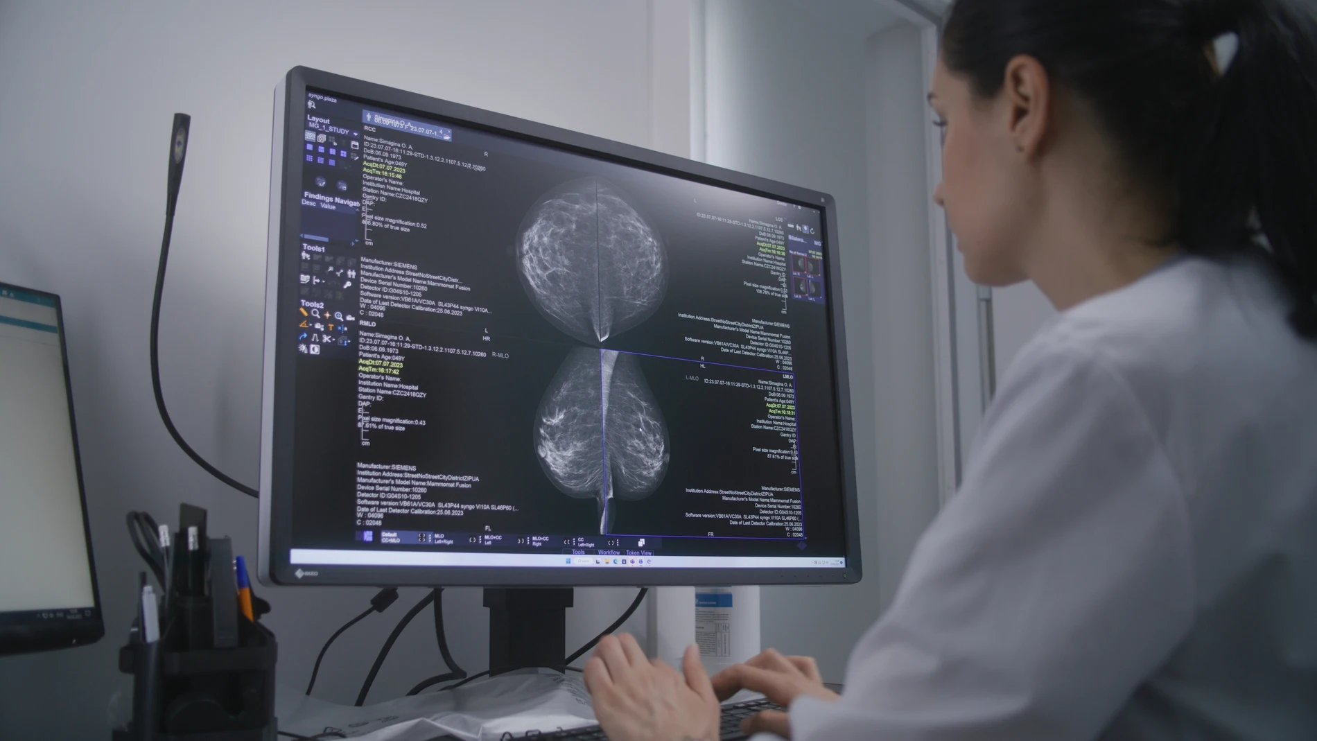 La detección temprana aumenta de manera significativa las posibilidades de curación del cáncer de mama