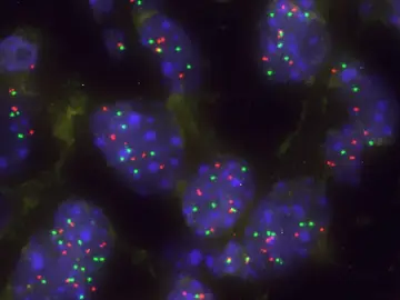 Imagen de un grupo de células tumorales pulmonares con aumento de KRAS para superar la barrera natural Capicua Imagen de un grupo de células tumorales pulmonares con aumento de KRAS para superar la barrera natural Capicua