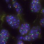 Imagen de un grupo de c&eacute;lulas tumorales pulmonares con aumento de KRAS para superar la barrera natural Capicua