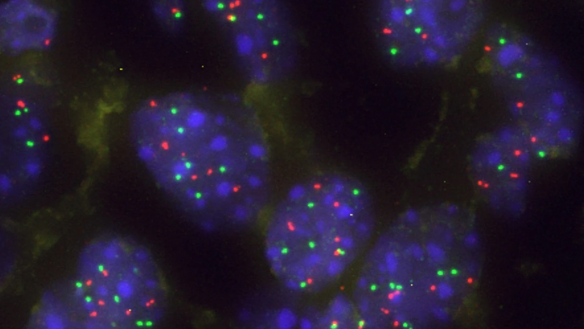 Imagen de un grupo de células tumorales pulmonares con aumento de KRAS para superar la barrera natural Capicua