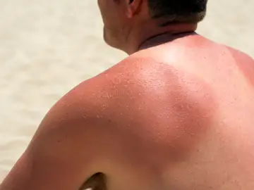 ¿Y si las quemaduras solares sirvieran para algo? La ciencia descubre que podrían ayudar a prevenir el cáncer ¿Y si las quemaduras solares sirvieran para algo? La ciencia descubre que podrían ayudar a prevenir el cáncer