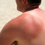 ¿Y si las quemaduras solares sirvieran para algo? La ciencia descubre que podrían ayudar a prevenir el cáncer ¿Y si las quemaduras solares sirvieran para algo? La ciencia descubre que podrían ayudar a prevenir el cáncer