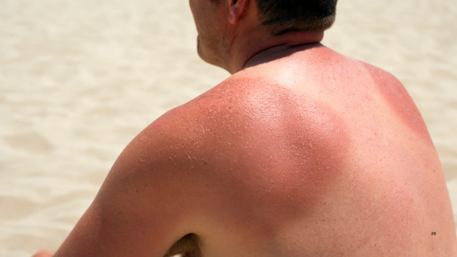 ¿Y si las quemaduras solares sirvieran para algo? La ciencia descubre que podrían ayudar a prevenir el cáncer