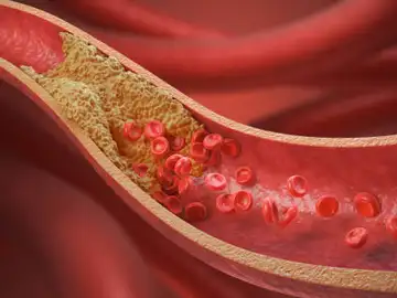 Una innovadora terapia genética consigue recortar a la mitad el colesterol en un ensayo con pacientes Una innovadora terapia genética consigue recortar a la mitad el colesterol en un ensayo con pacientes