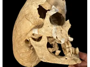 El cráneo corresponde a un individuo de entre 45 y 49 años. Historia