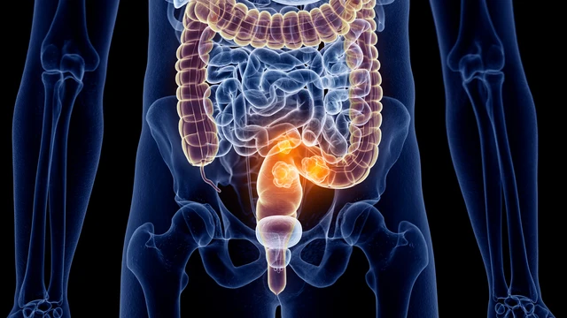 Este año se registrarán 44.573 nuevos casos de cáncer de colon y recto en España