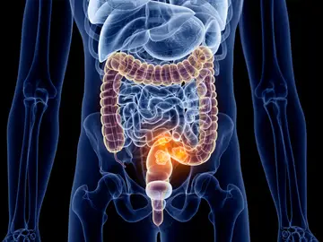 Este año se registrarán 44.573 nuevos casos de cáncer de colon y recto en España Este año se registrarán 44.573 nuevos casos de cáncer de colon y recto en España
