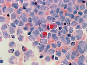 ¿Existe una proteína que alimenta al cáncer y que debemos evitar consumir? ¿Existe una proteína que alimenta al cáncer y que debemos evitar consumir?