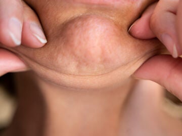 Cara ozempic: cuando bajar de peso de forma acelerada envejece el rostro