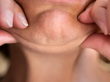 Cara ozempic: cuando bajar de peso de forma acelerada envejece el rostro Cara ozempic: cuando bajar de peso de forma acelerada envejece el rostro