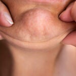 Cara ozempic: cuando bajar de peso de forma acelerada envejece el rostro