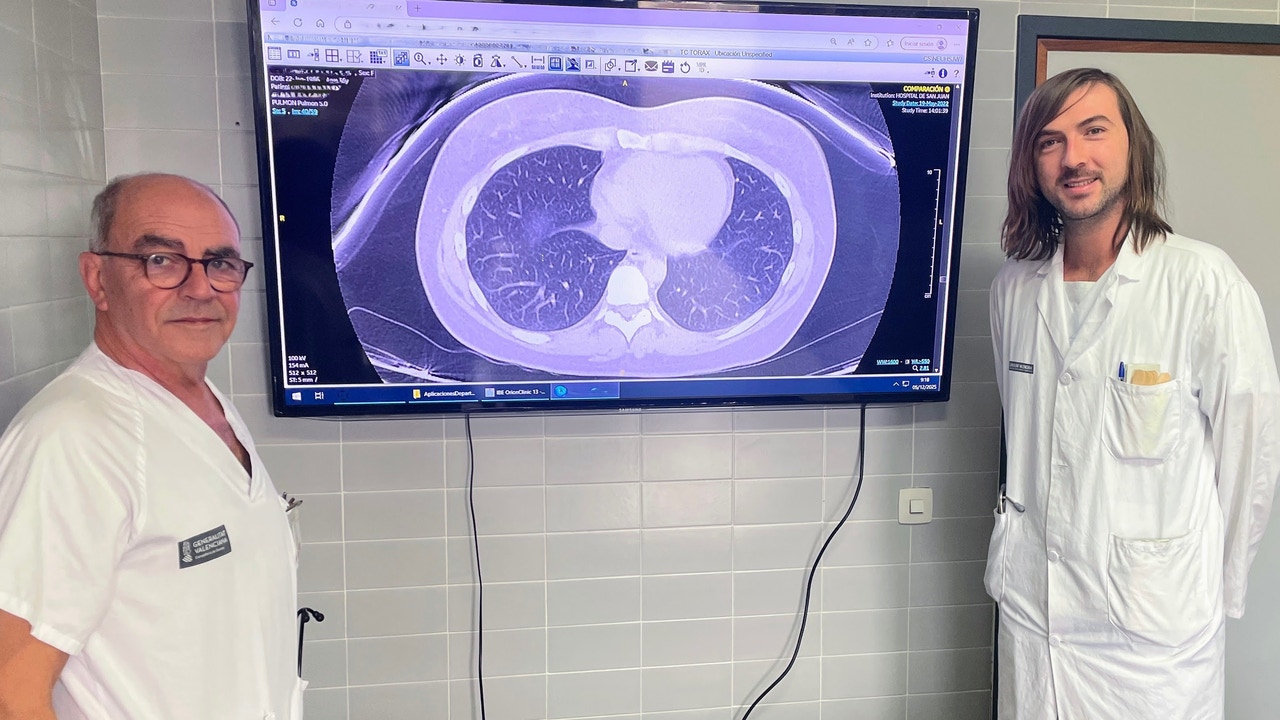 El Hospital Sant Joan d’Alacant desarrolla una IA que predice la respuesta al tratamiento biológico del asma grave